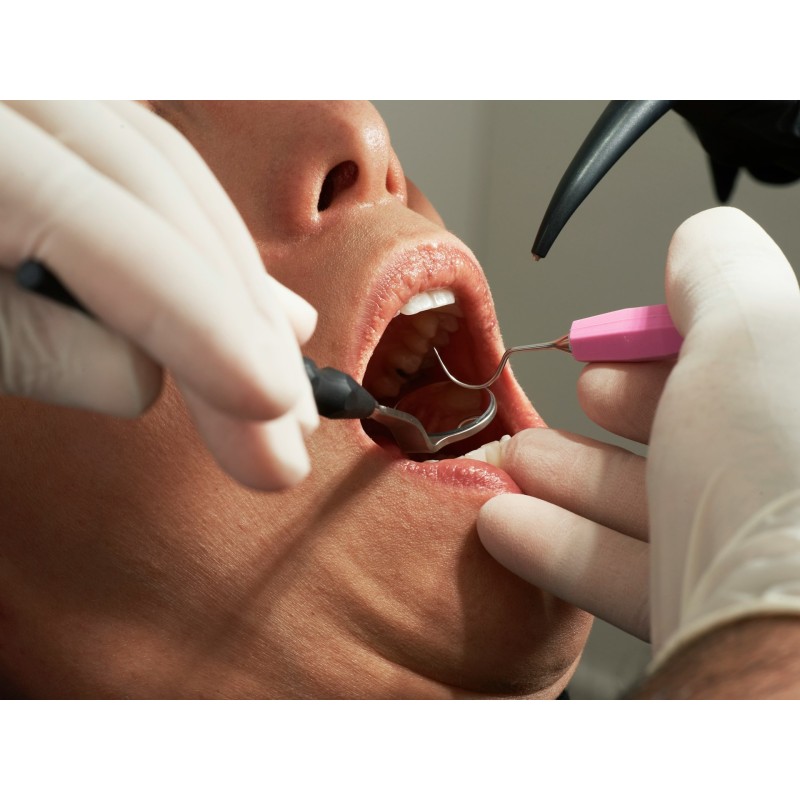 Tratament Endodontic